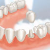 What's a Dental Crown