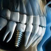 Dental Implants Part II
