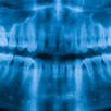 Wisdom Teeth