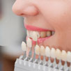 Veneers