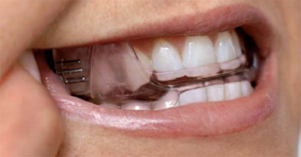 Sleep Apnea appliance