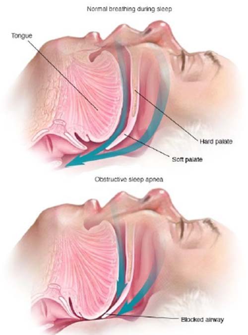 Sleep Apnea breath comparison