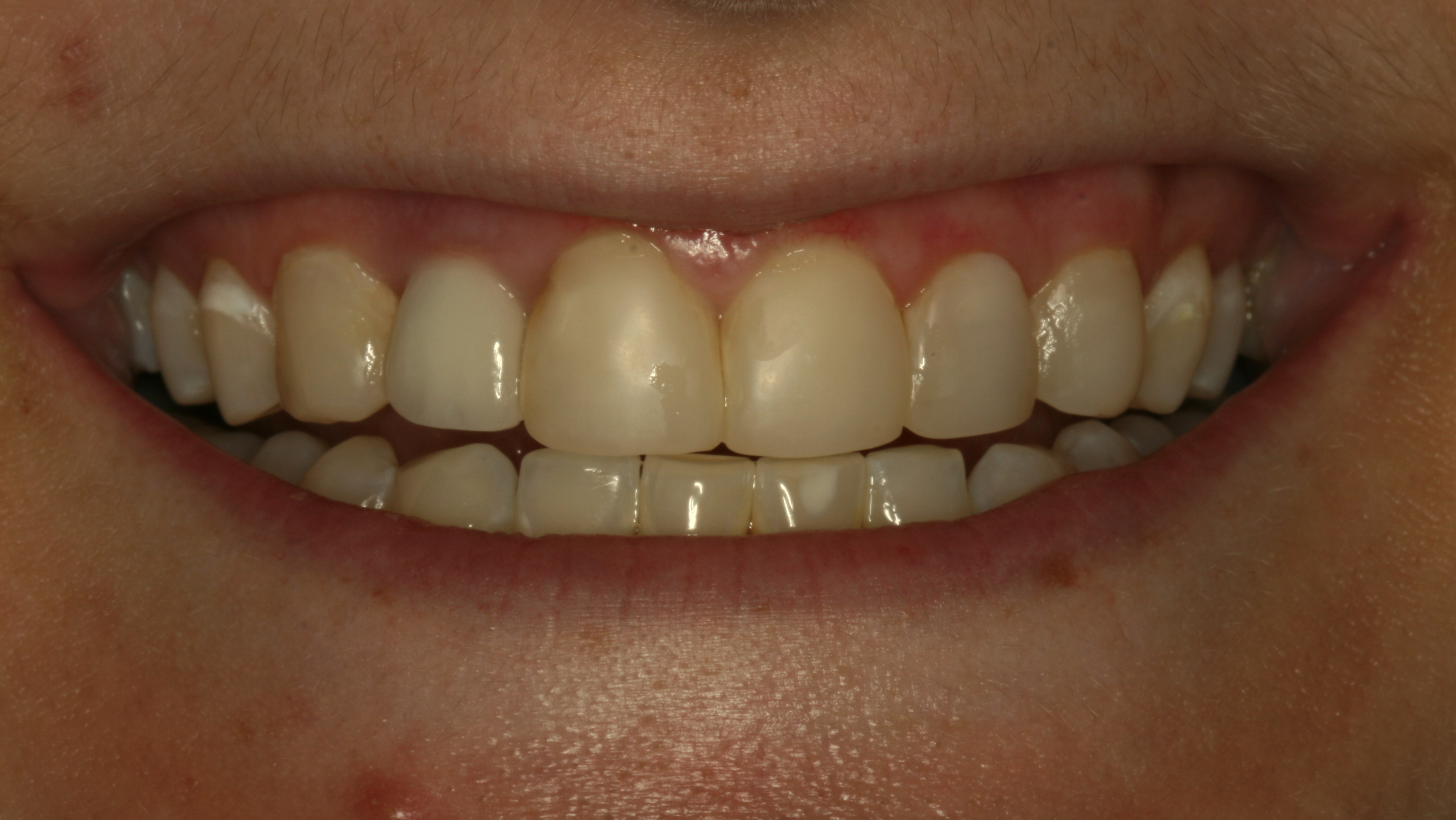 Smiles By Dr. Gibson Smile Makeover 9