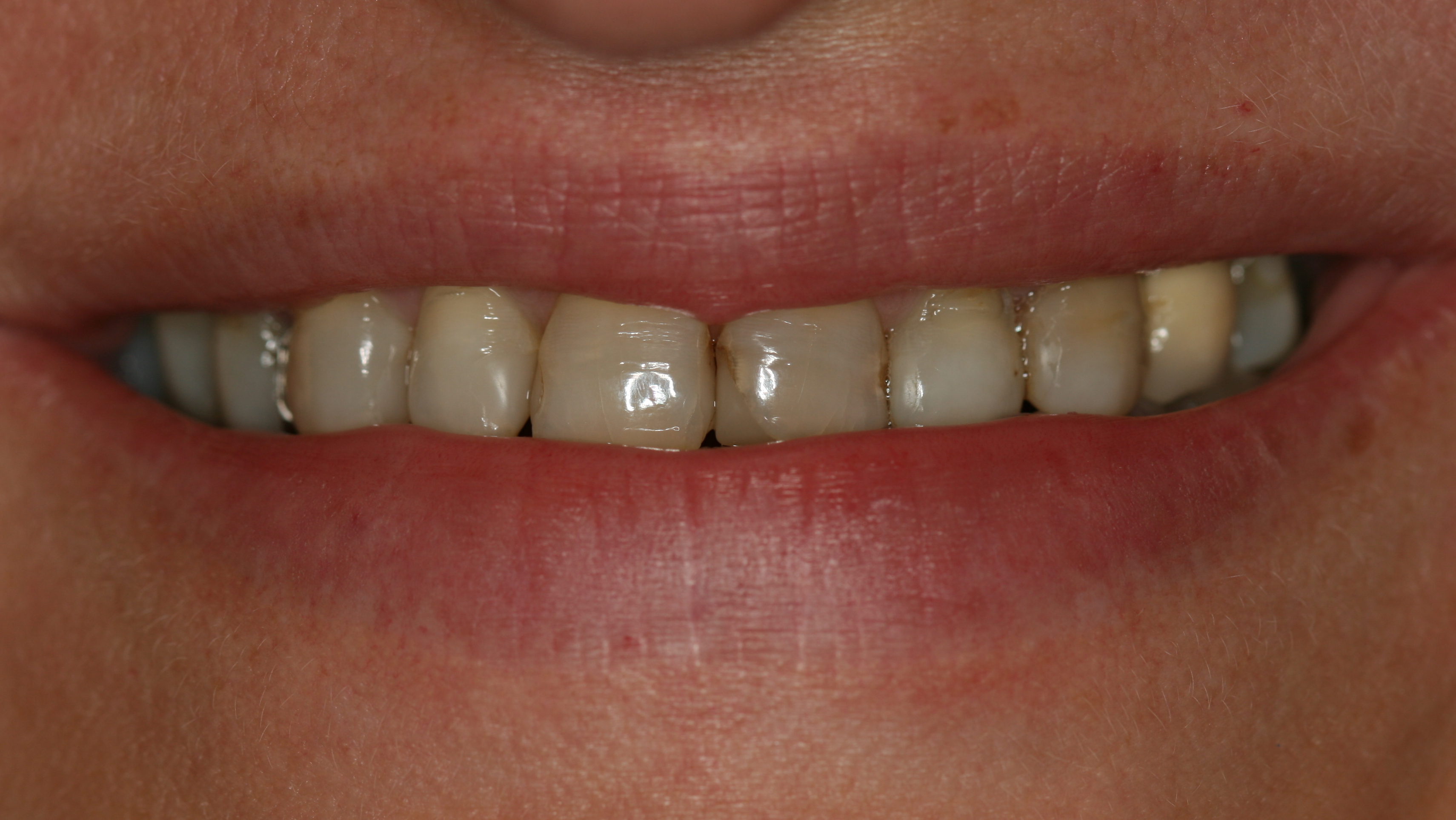 Smiles By Dr. Gibson Smile Makeover 10