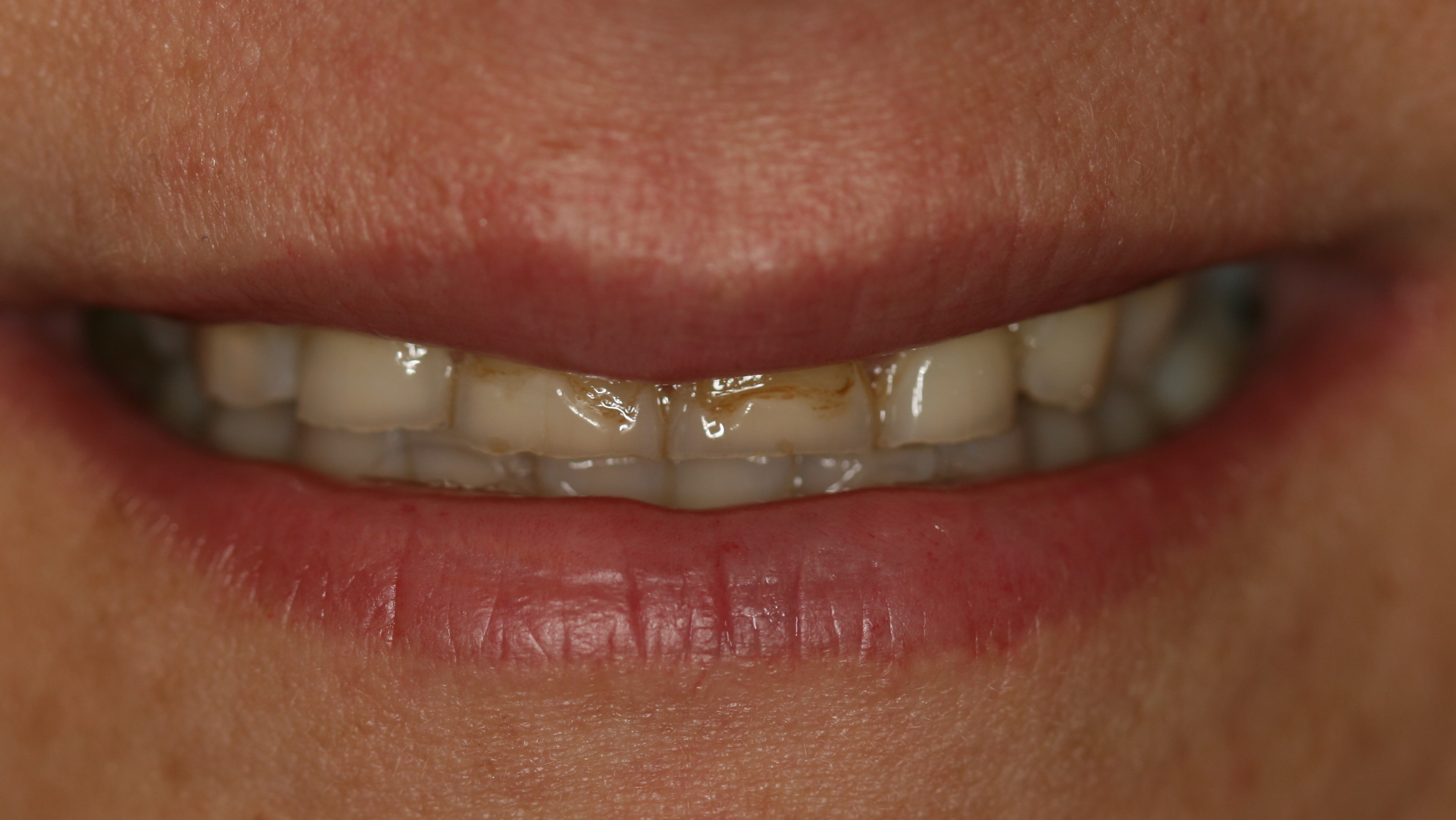 Smiles By Dr. Gibson Smile Makeover 11
