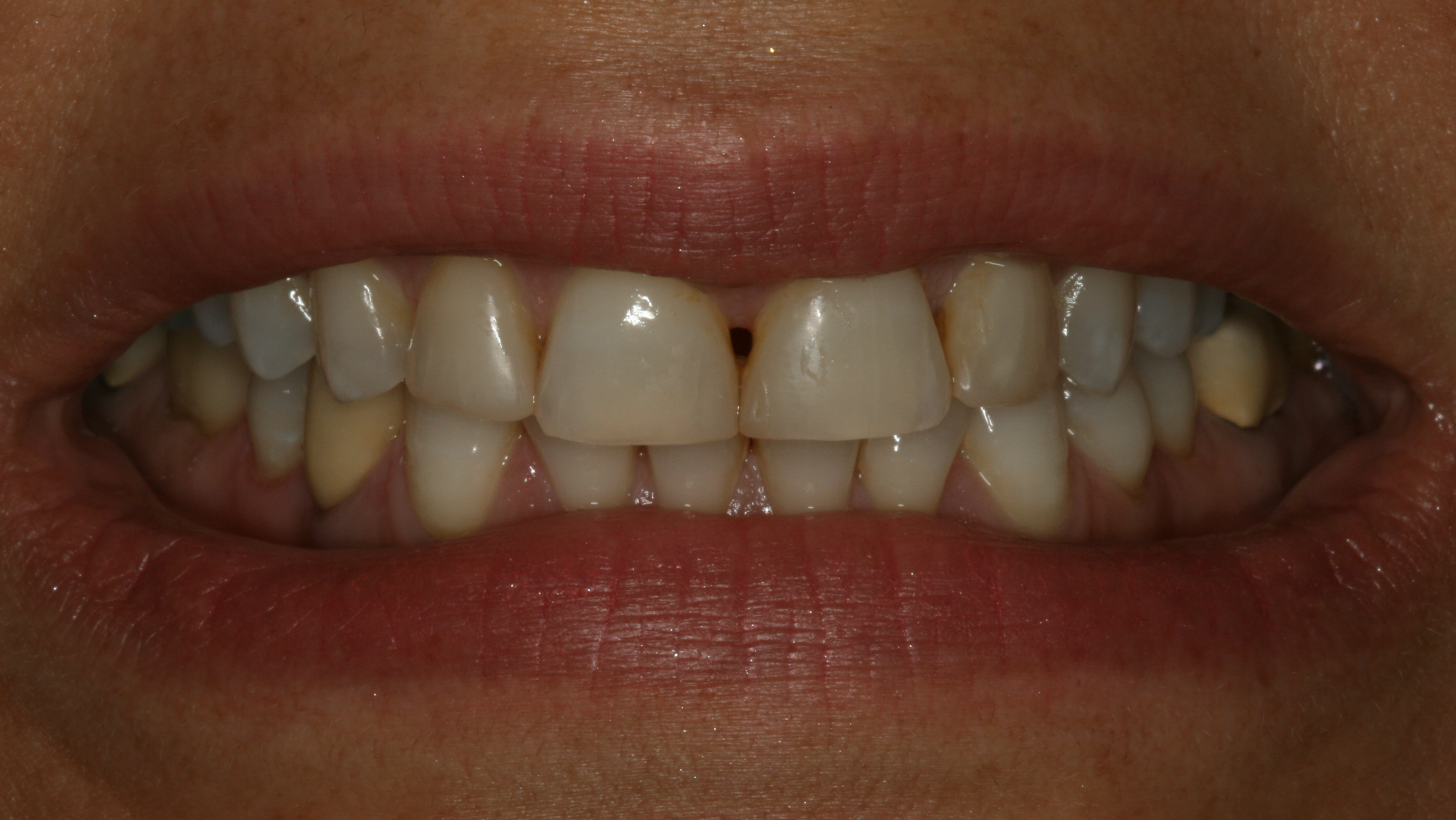 Smiles By Dr. Gibson Smile Makeover 12