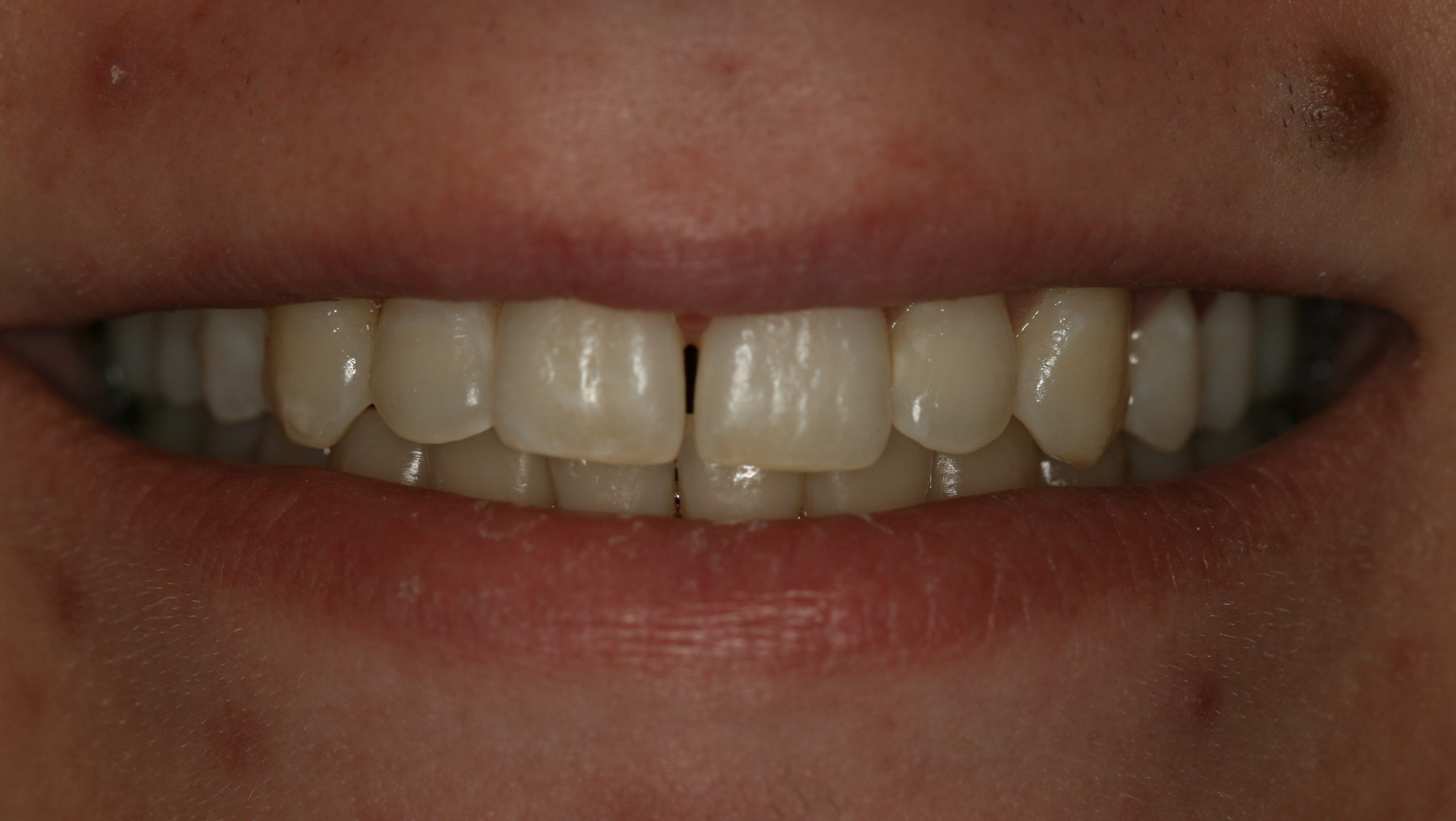 Smiles By Dr. Gibson Smile Makeover 13