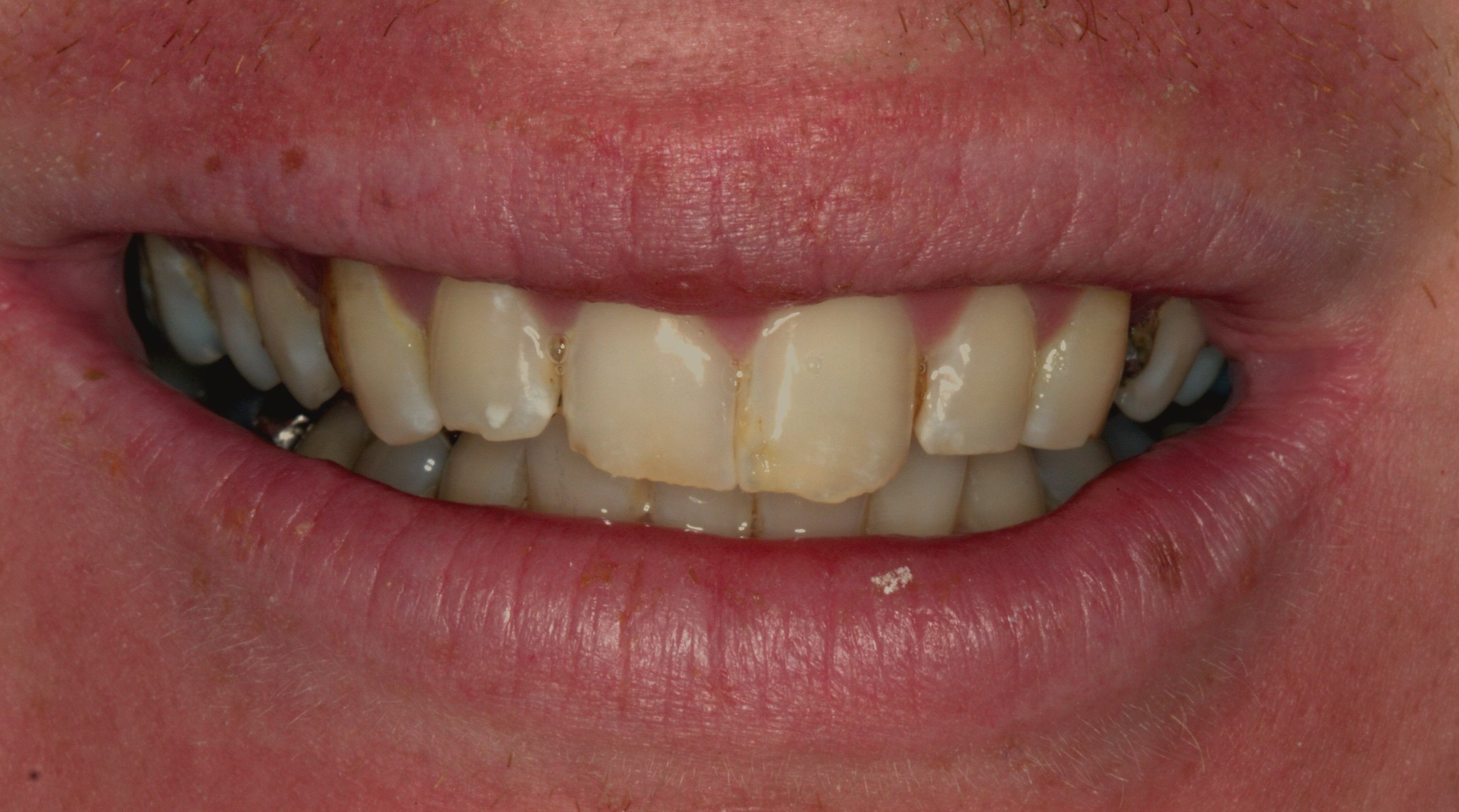 Smiles By Dr. Gibson Smile Makeover 14