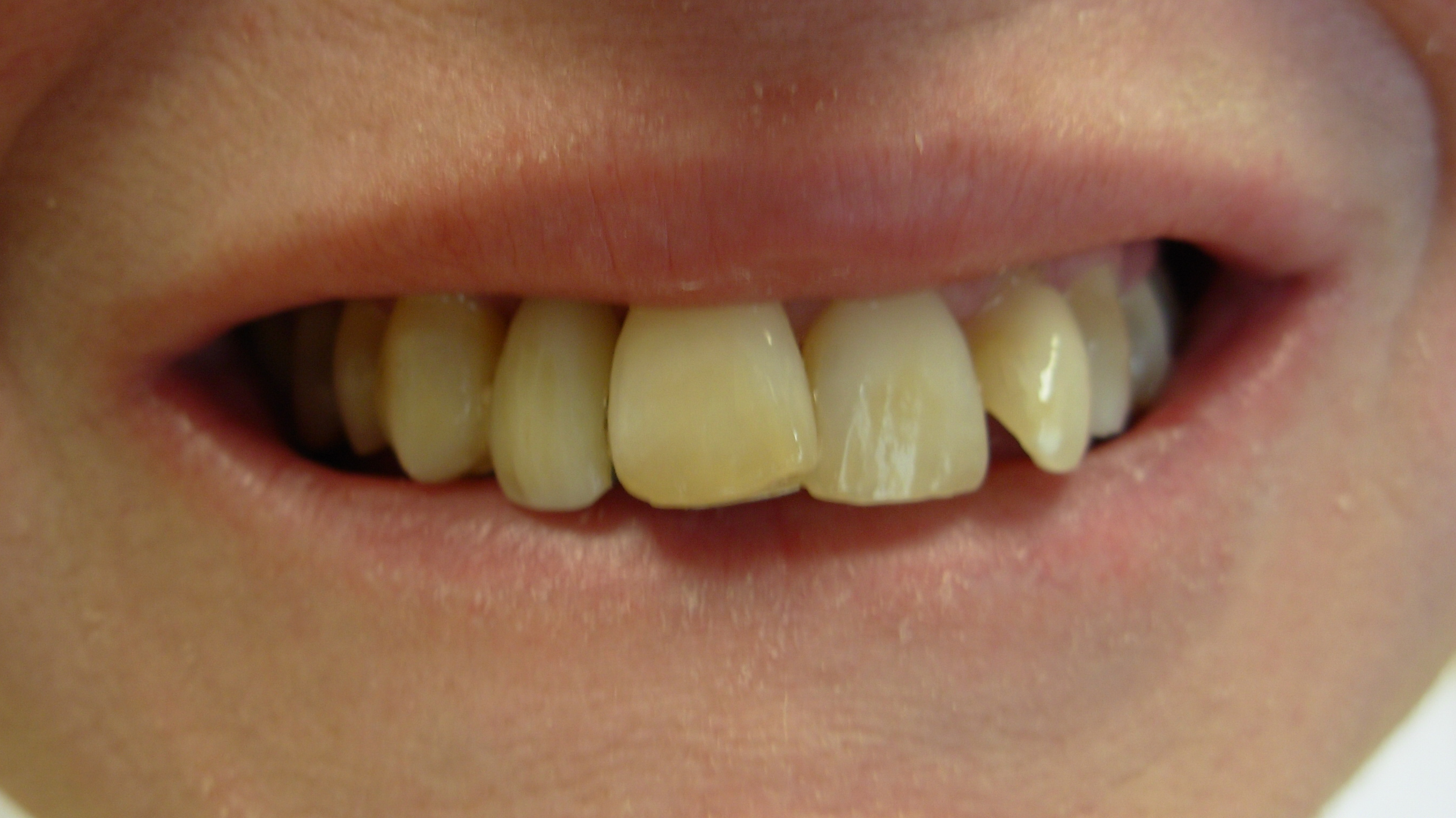Smiles By Dr. Gibson Smile Makeover 15
