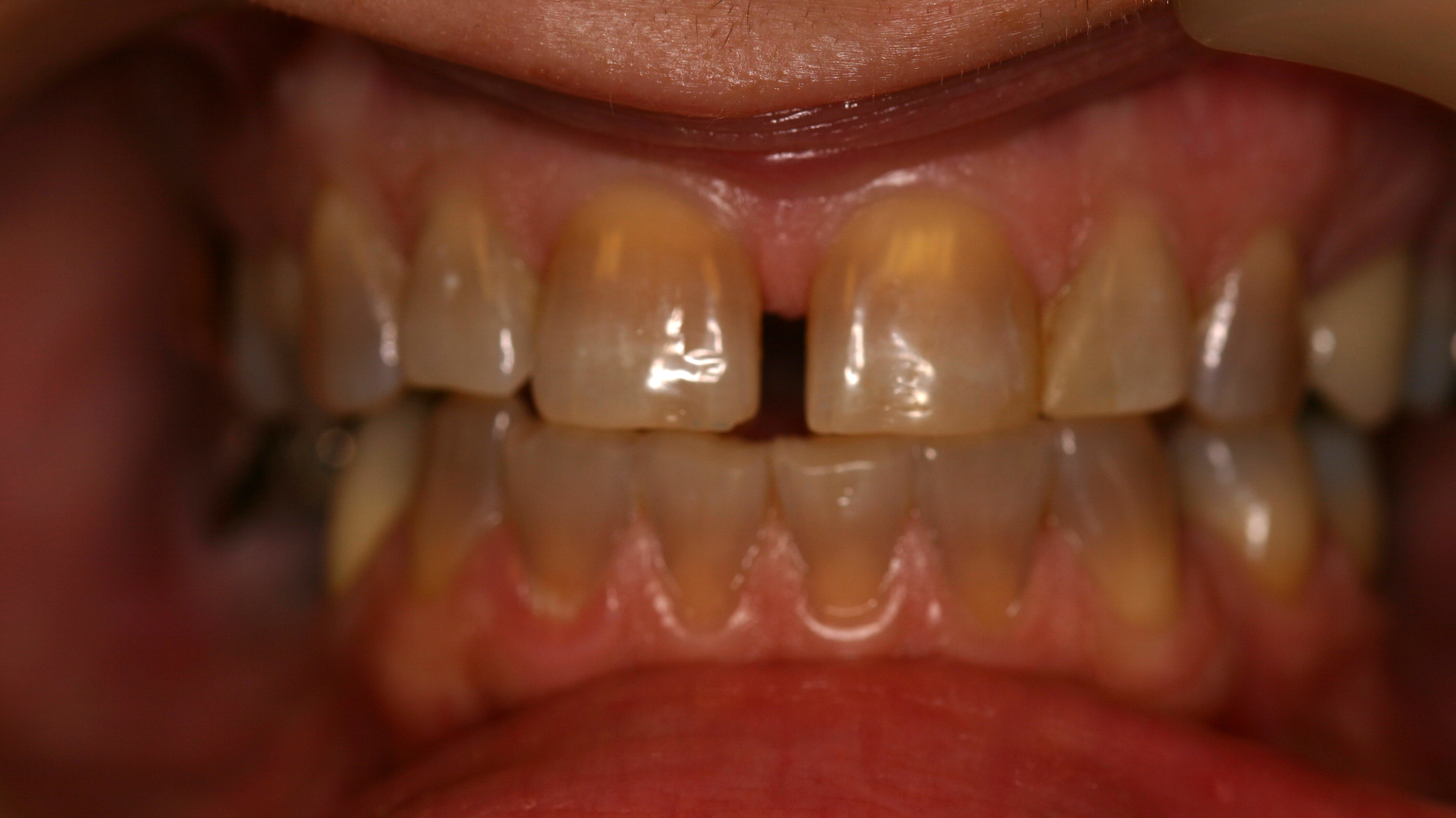 Smiles By Dr. Gibson Smile Makeover 1