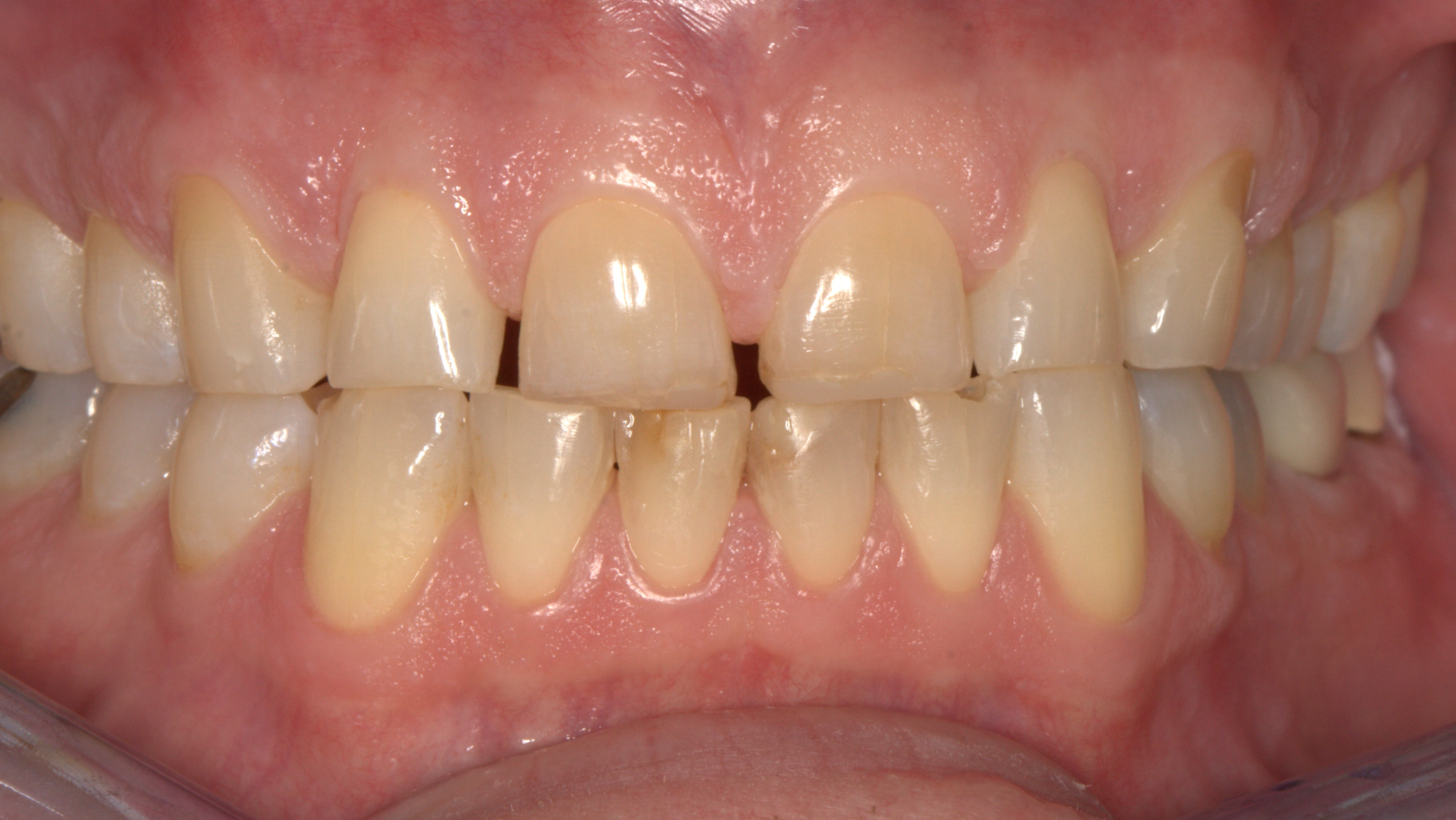 Smiles By Dr. Gibson Smile Makeover 16