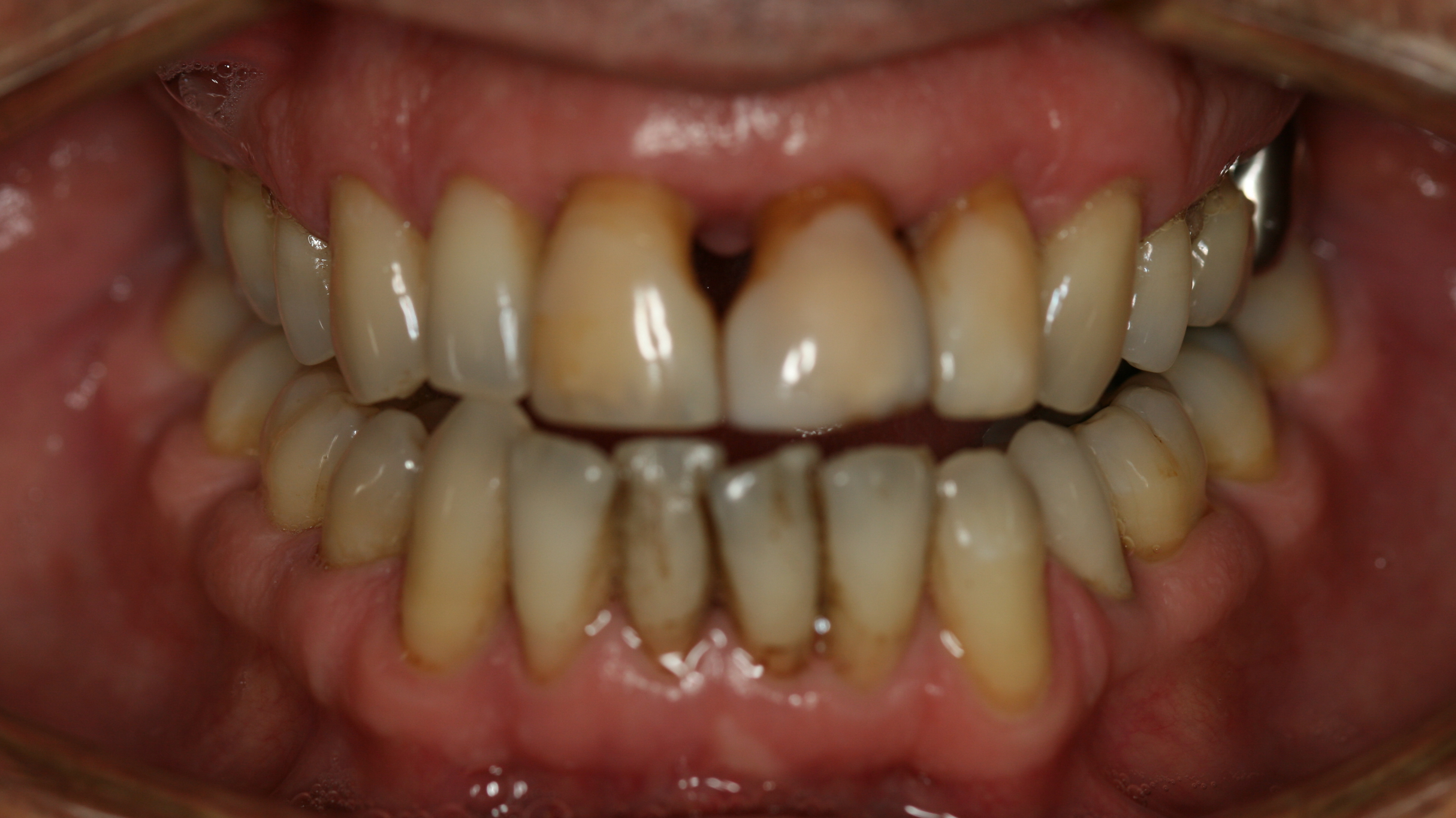 Smiles By Dr. Gibson Smile Makeover 3