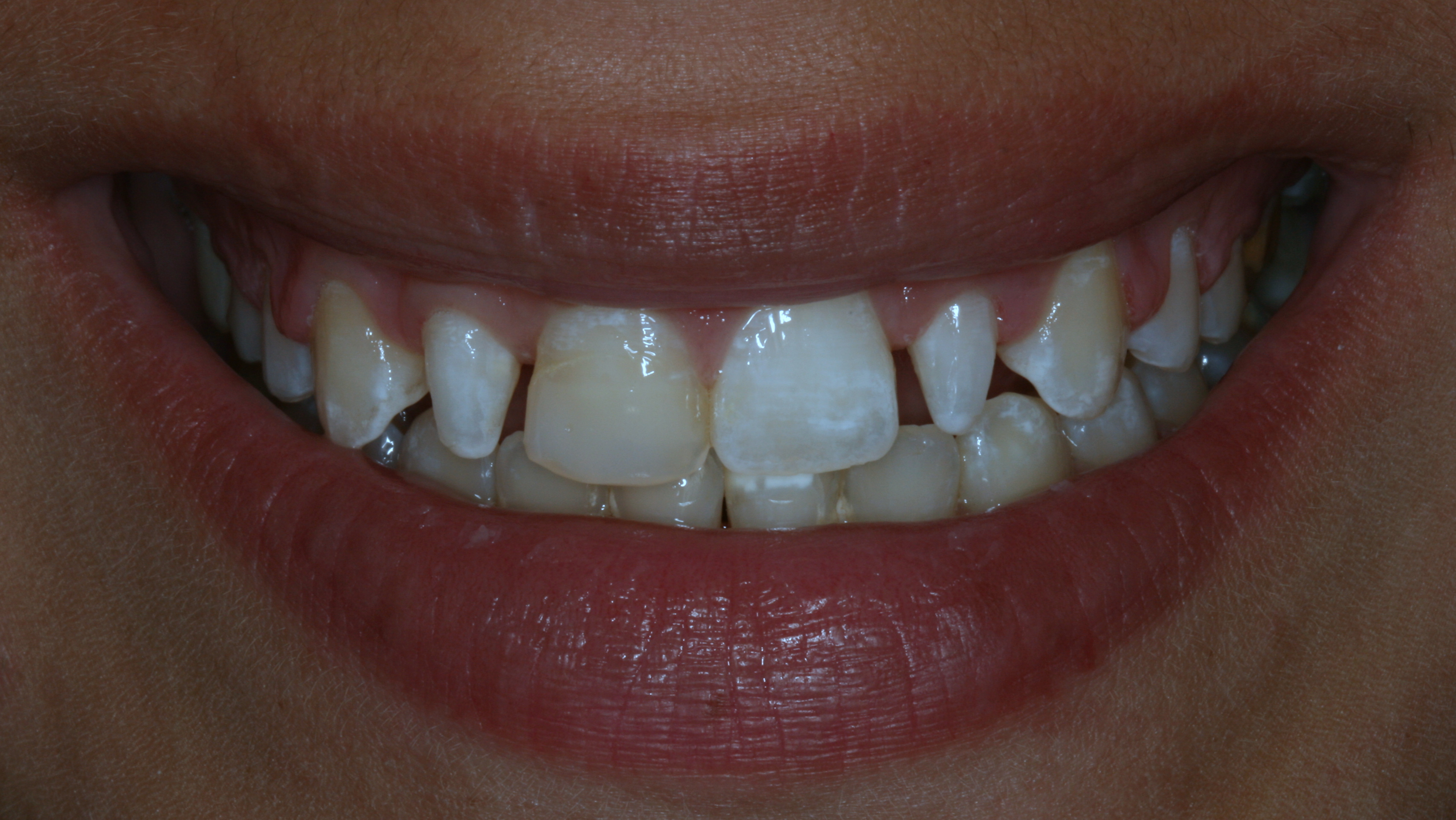 Smiles By Dr. Gibson Smile Makeover 4