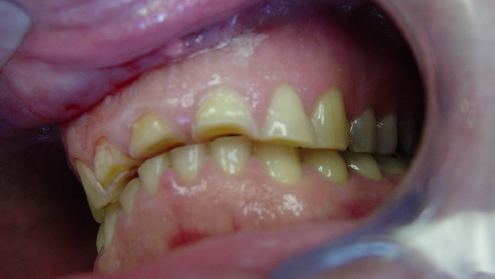 Smiles By Dr. Gibson Smile Makeover 6