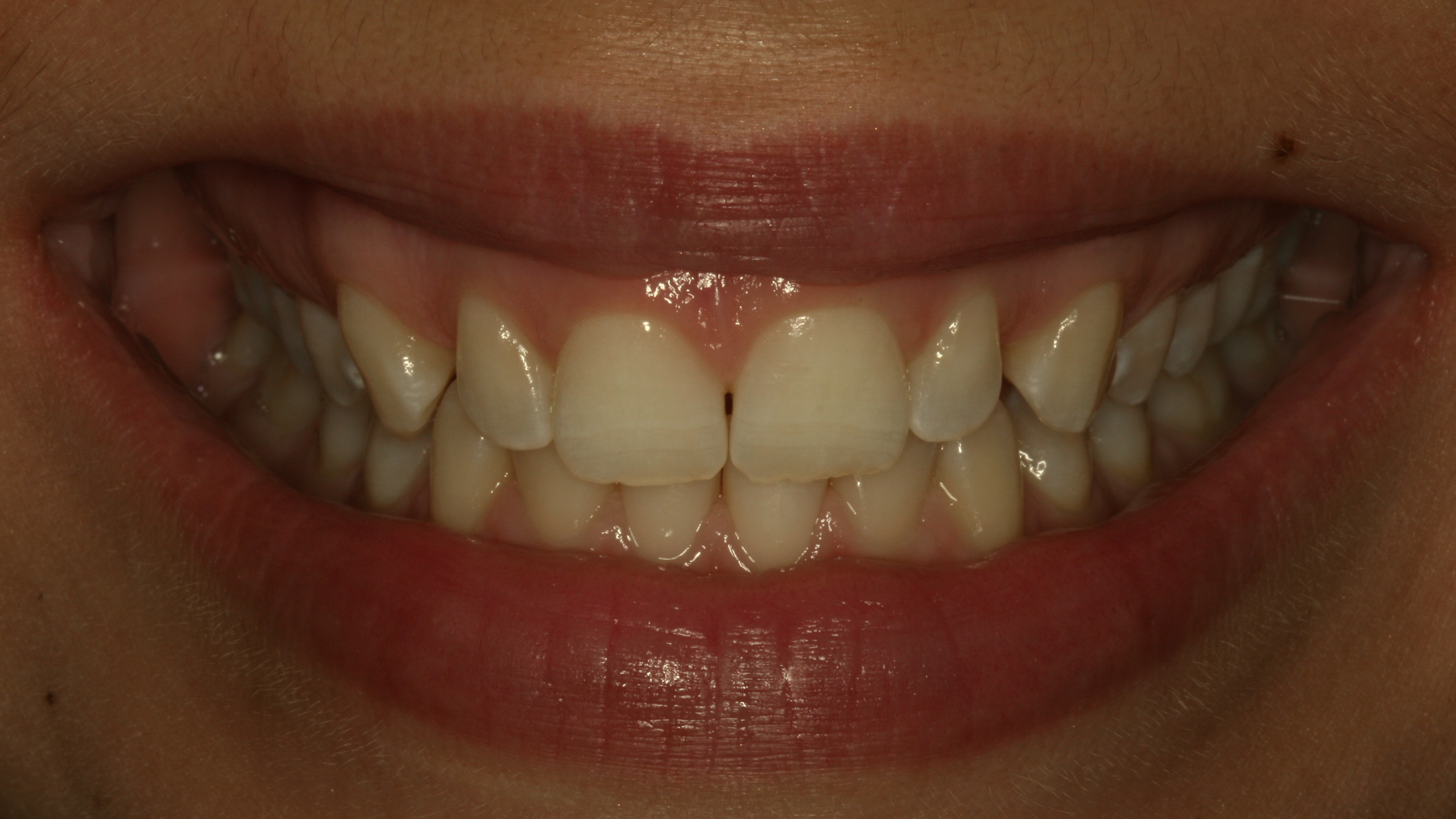 Smiles By Dr. Gibson Smile Makeover 7