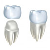 Crowns, Inlays, & Onlays