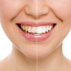 Dental Bonding