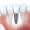 Dental Implant Restorations
