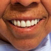 Full-Mouth Reconstruction