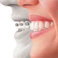 Invisalign Clear Braces