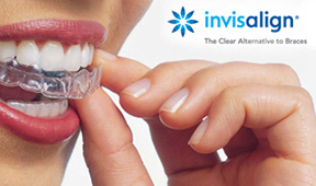 Invisalign