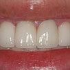 Laser Gum Recontouring